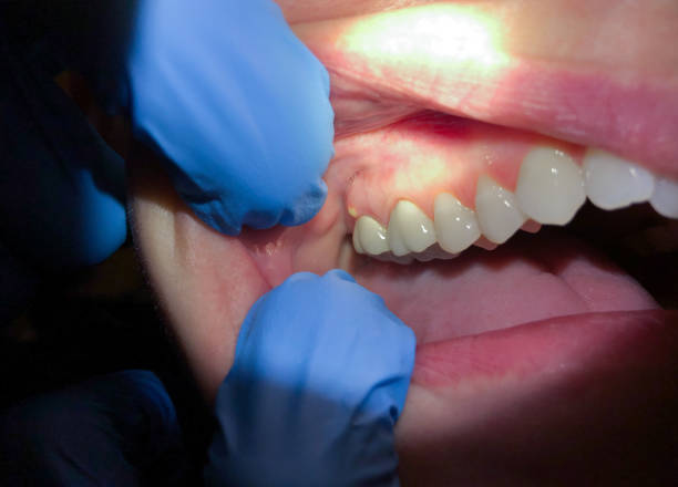 Best Tooth Infection Emergency Dentist  in Lightstreet, PA